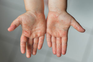 common childhood illness hand foot mouth disease