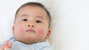 eczema common childhood illnesses